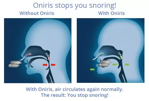 With and without ONIRIS1